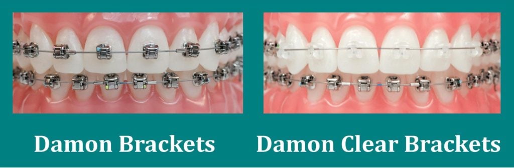 Damon Braces - The Latest in Orthodontics